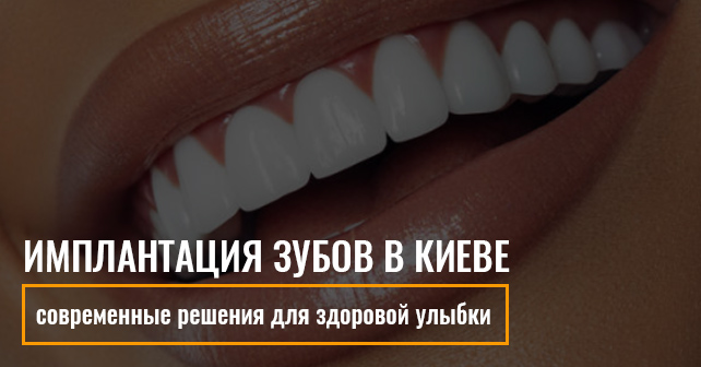 Имплантация зубов в Киеве