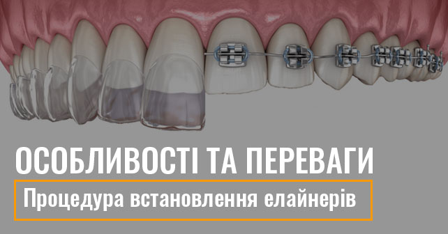 Процедура встановлення елайнерів: особливості та переваги